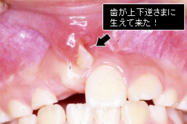 不正な位置（萌出異常）不正な位置（萌出異常）