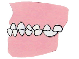 2.受け口(反対の噛み合わせ)