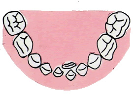6.乳歯が抜けないのに後ろから永久歯が生えてきた