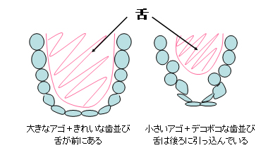 小さいアゴ